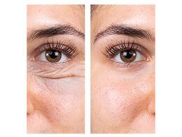 blefaroplastia bolsas en los párpados