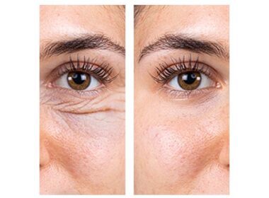 blefaroplastia bolsas en los párpados