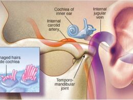 el nuevo zumbido sobre el tinnitus detección