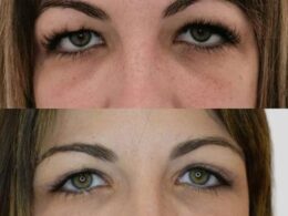 hablamos de la blefaroplastia riesgos y beneficios