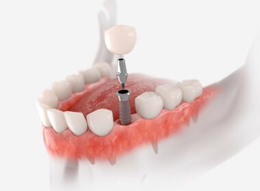 implantes de carga inmediata ttfa