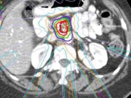 la radioterapia estereotáctica ralentiza la progresión del cáncer de páncreas en pacientes inoperables