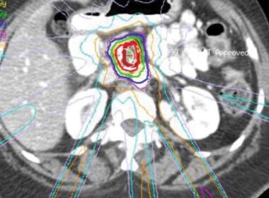 la radioterapia estereotáctica ralentiza la progresión del cáncer de páncreas en pacientes inoperables