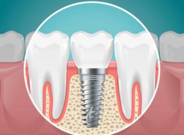 los implantes dentales en sydney lo que implica publicado el procedimiento por isabel rucker