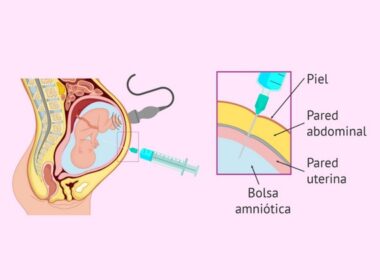 preguntas frecuentes la amniocentesis