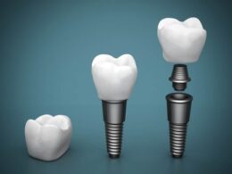 principales tipos de implantes dentales y sus beneficios