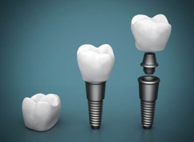 principales tipos de implantes dentales y sus beneficios