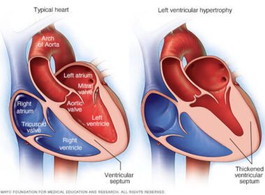 Hipertrofia ventricular